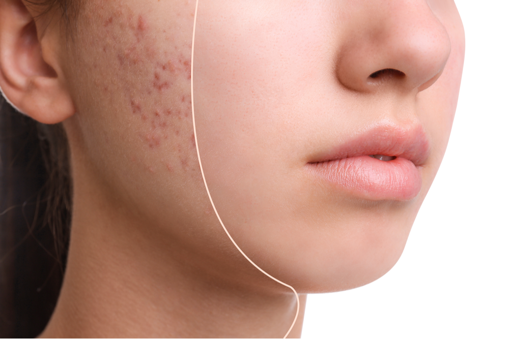 Mesotherapy in Dubai by Cosmocare Medical Center